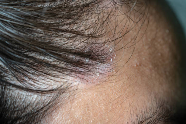 Scalp Psoriasis v Dandruff