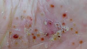 Pustular Psoriasis