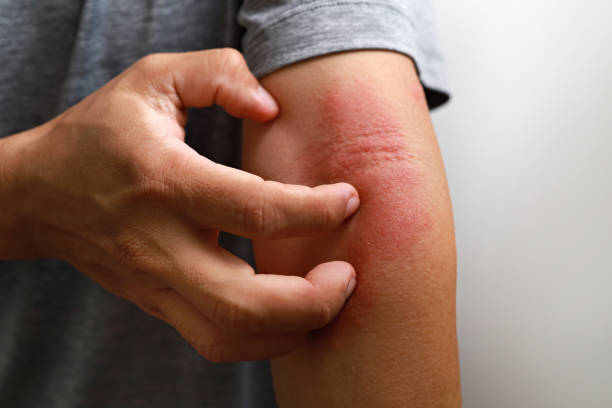 Red Itchy Skin Australia