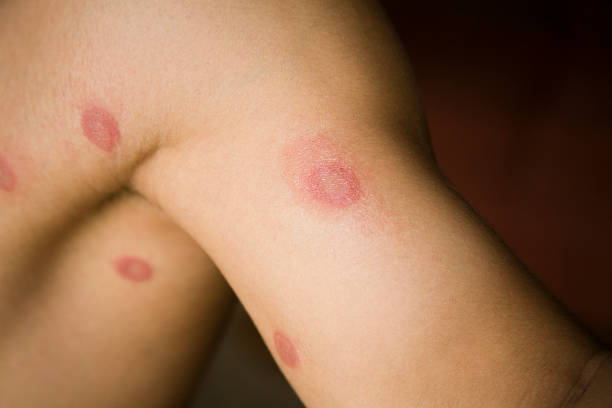 Psoriasis vs Ringworm Australia