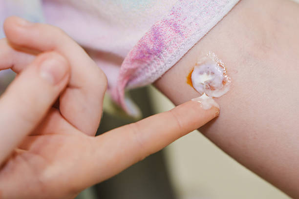 Ringworm Cream Australia