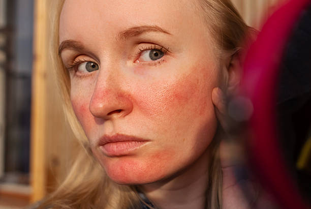 Red Light Therapy for Rosacea Australia