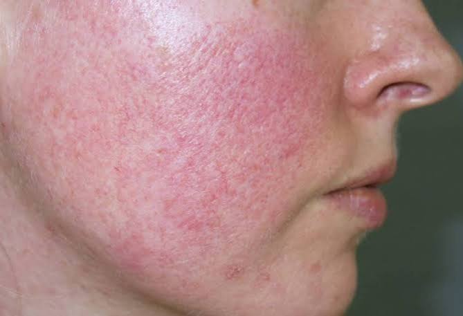 Is Rosacea Curable Australia
