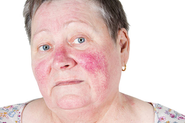 Rosacea Australia