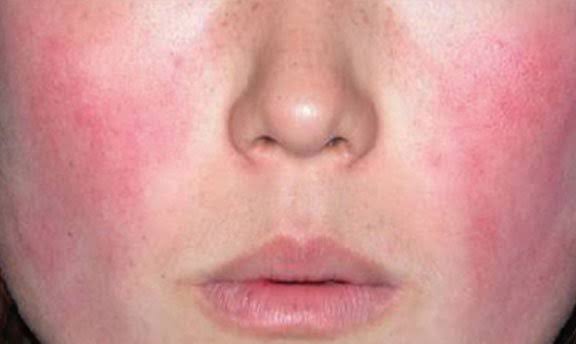 Is Rosacea an Autoimmune Disease Australia