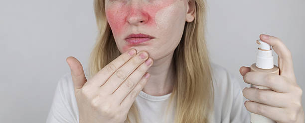 Rosacea Cream Australia