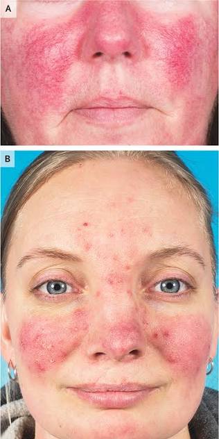 Rosacea Flare Ups Australia