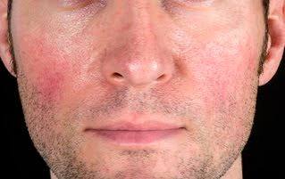 Rosacea in Men Australia