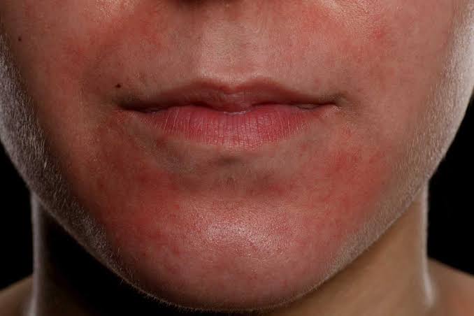 Rosacea on Chin Australia