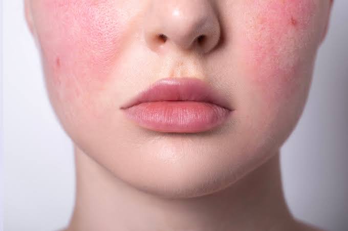 Rebound Redness From Rosacea Gel Australia