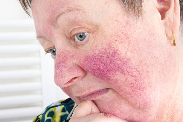 The Rosacea Flushing and Stress Cycle Australia