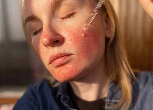Rosacea Treatment Australia