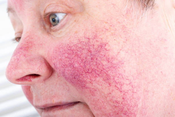 Rosacea Triggers Australia