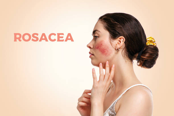 Types of Rosacea Australia