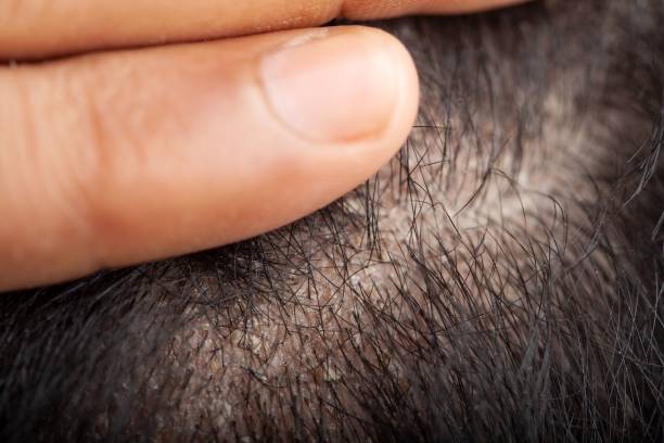 Scalp Buildup Australia