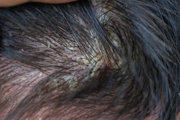 Dermatitis on Scalp vs Psoriasis