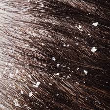 Scalp Eczema Shampoo Australia