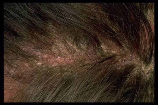 Dandruff Shampoo for Scalp Eczema Australia