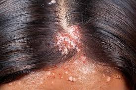 Seborrheic Dermatitis vs Psoriasis on Scalp