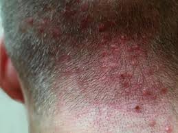 How to Treat Scalp Folliculitis at Home Australia