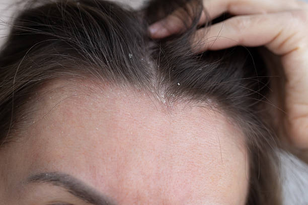 Scalp Irritation From Shampoo Australia