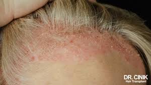 dry shampoo and scalp psoriasis australia