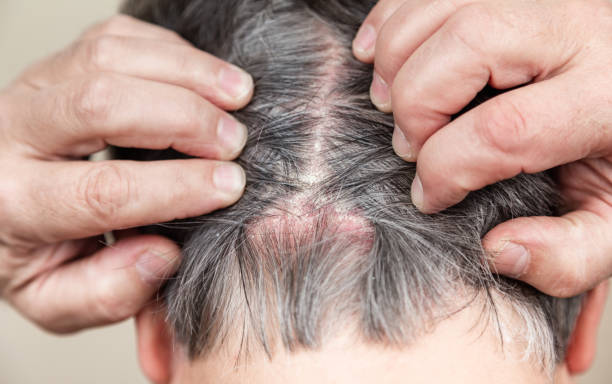 Shampoo for Psoriasis Scalp Australia