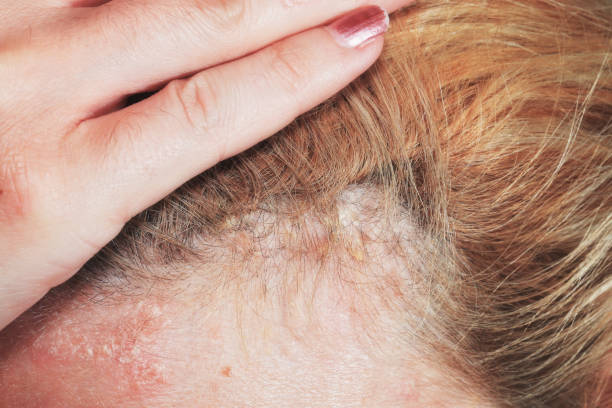 does scalp psoriasis cause hair loss