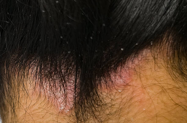 Scalp Psoriasis and Winter Australia