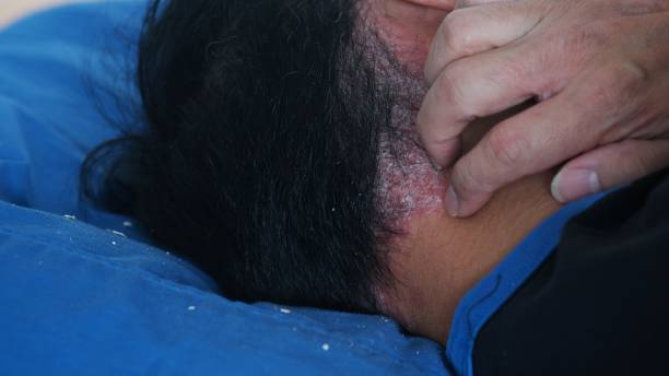 how to remove scalp psoriasis scales safely australia