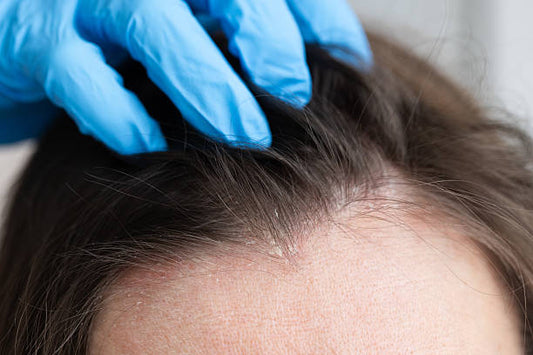 Scalp Psoriasis Treatment