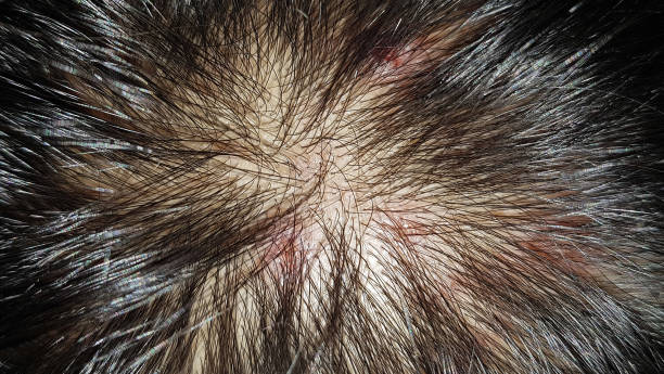 scalp skin barrier support for psoriasis australia