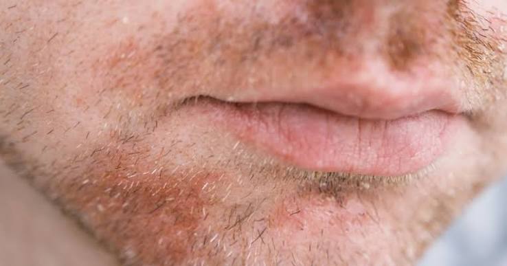 Seborrheic Dermatitis on Face Australia
