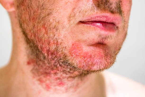 Seborrheic Dermatitis Triggers Australia