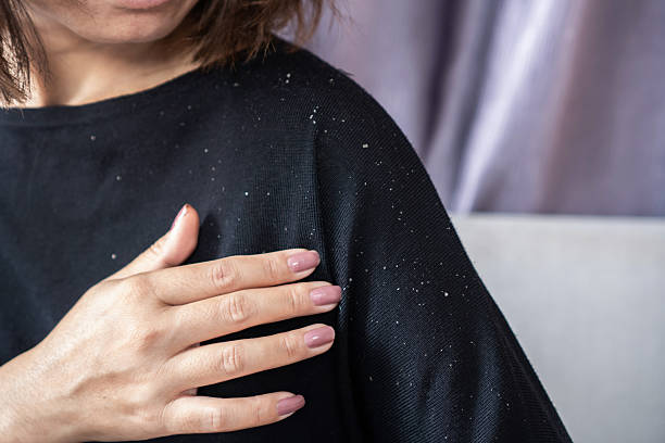 Best Shampoo for Eczema