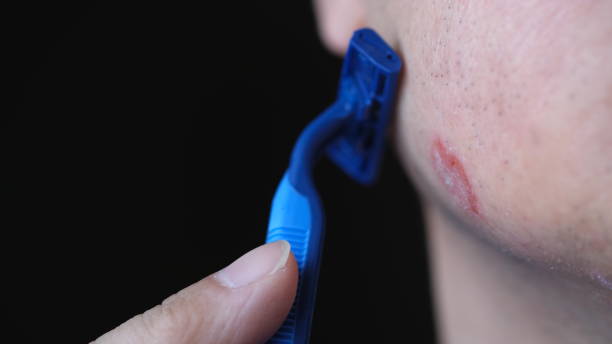 Can You Shave With Eczema Australia