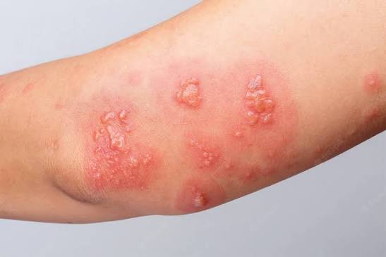 Bee Venom for Shingles