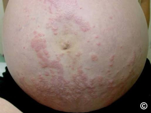 Managing a Skin Flare During Pregnancy Australia