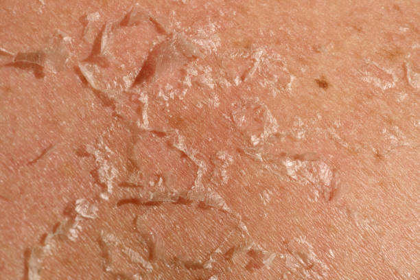 Skin Peeling Australia