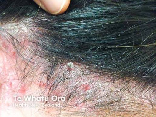 Scalp Psoriasis in Summer Australia