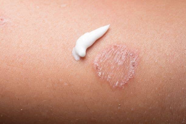 Can Steroid Cream Make Tinea Worse Australia