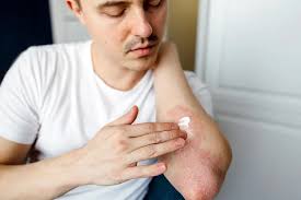 Psoriasis and Sunscreen Australia