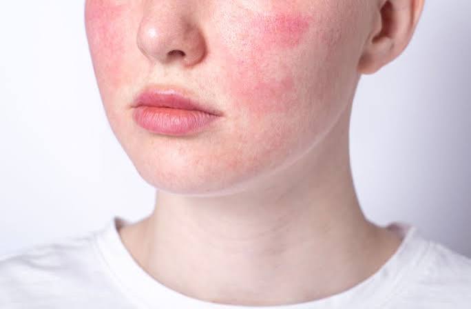 Best Sunscreen for Rosacea Australia