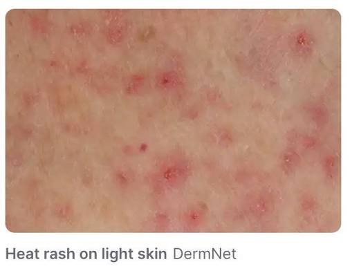Sweat Rash Australia