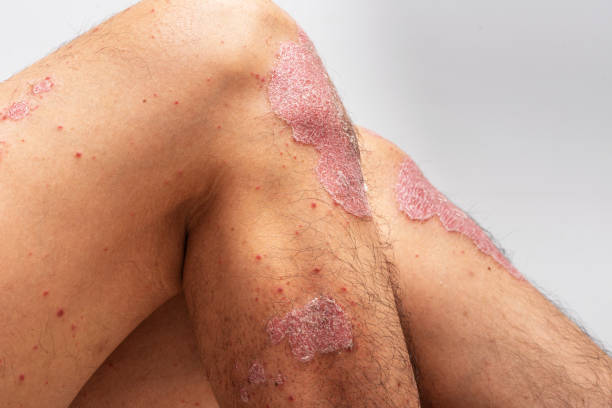 Psoriasis Cream for Thick Plaques Australia