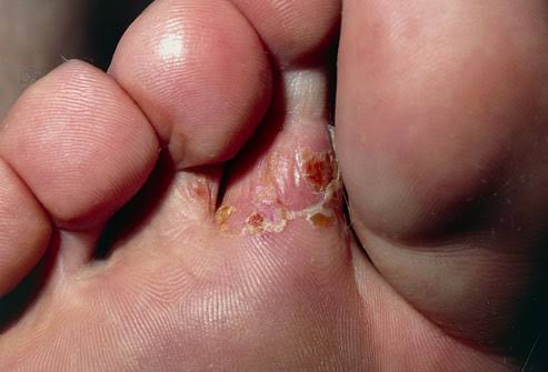 Can Diet Help Tinea Australia