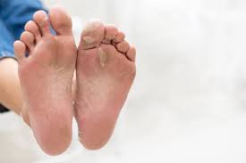 Tinea and Fragrance Australia
