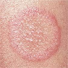 Tinea on Face Australia