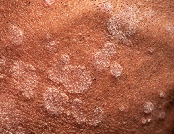 Tinea on Scalp Australia