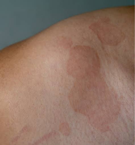 Tinea Versicolor Australia